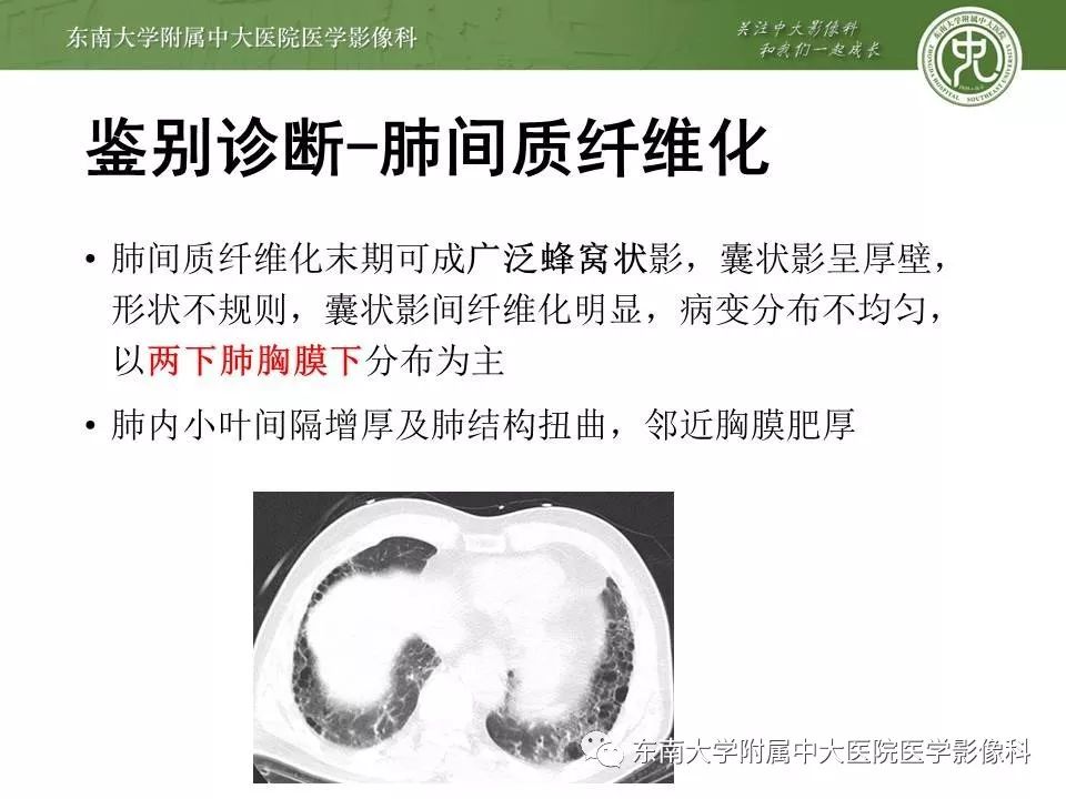 【PPT】肺淋巴管肌瘤病的影像