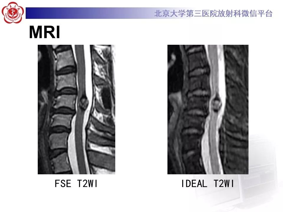 【PPT】椎管内海绵状血管瘤的影像