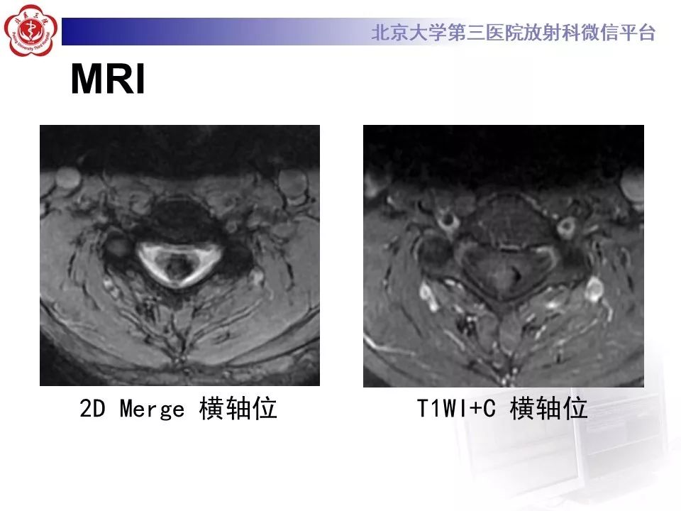 【PPT】椎管内海绵状血管瘤的影像
