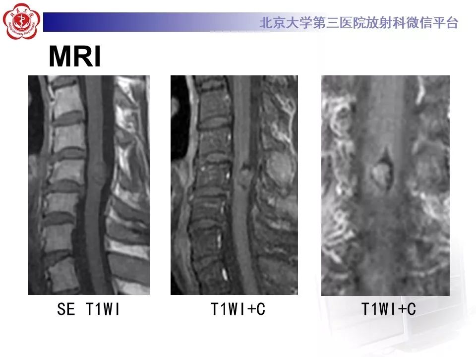 【PPT】椎管内海绵状血管瘤的影像