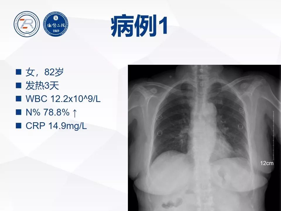【PPT】新型冠状病毒肺炎早知道—胸片细节见真章（肺炎和病毒性肺炎X线诊断