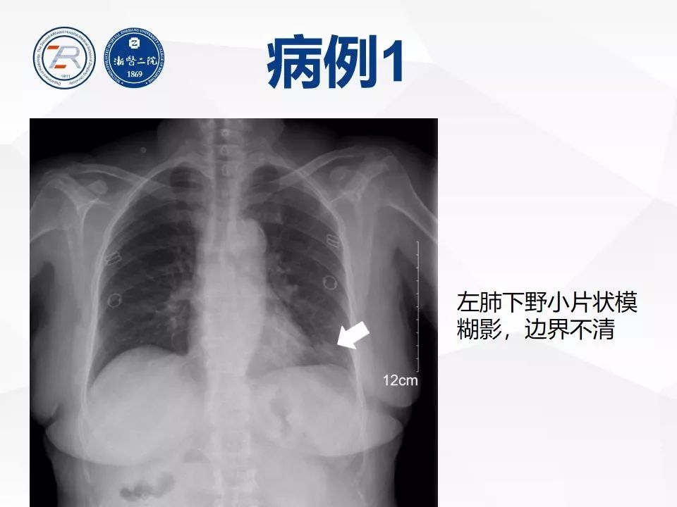 【PPT】新型冠状病毒肺炎早知道—胸片细节见真章（肺炎和病毒性肺炎X线诊断