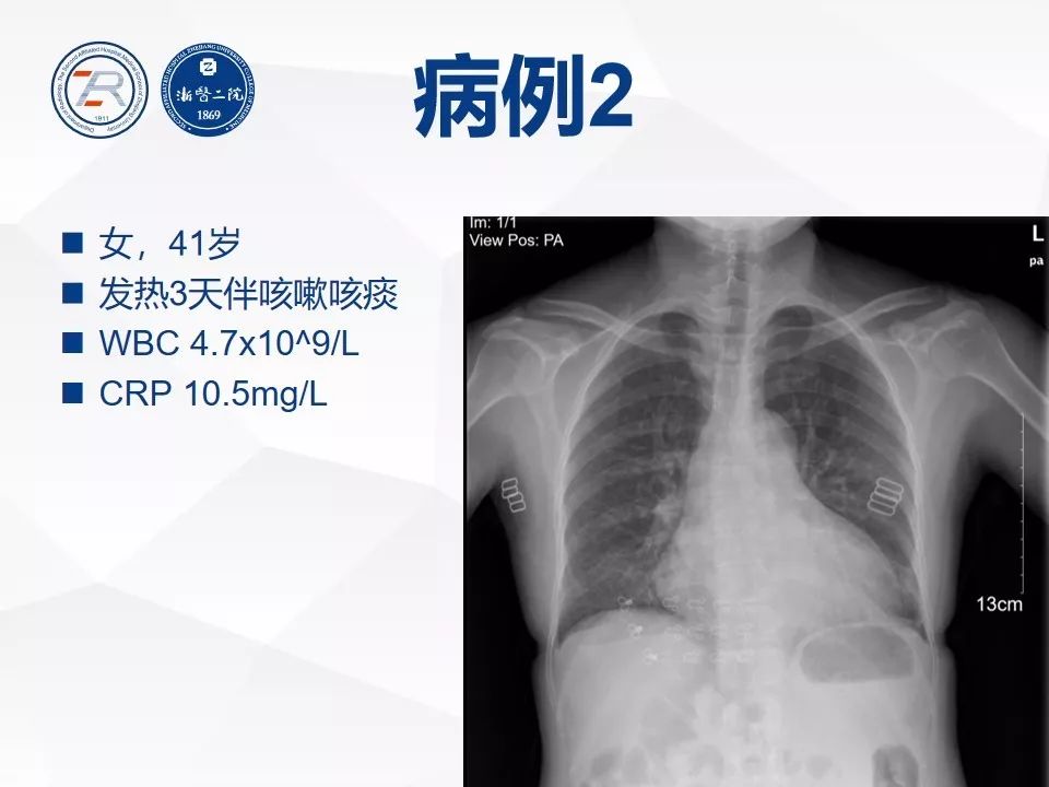 【PPT】新型冠状病毒肺炎早知道—胸片细节见真章（肺炎和病毒性肺炎X线诊断