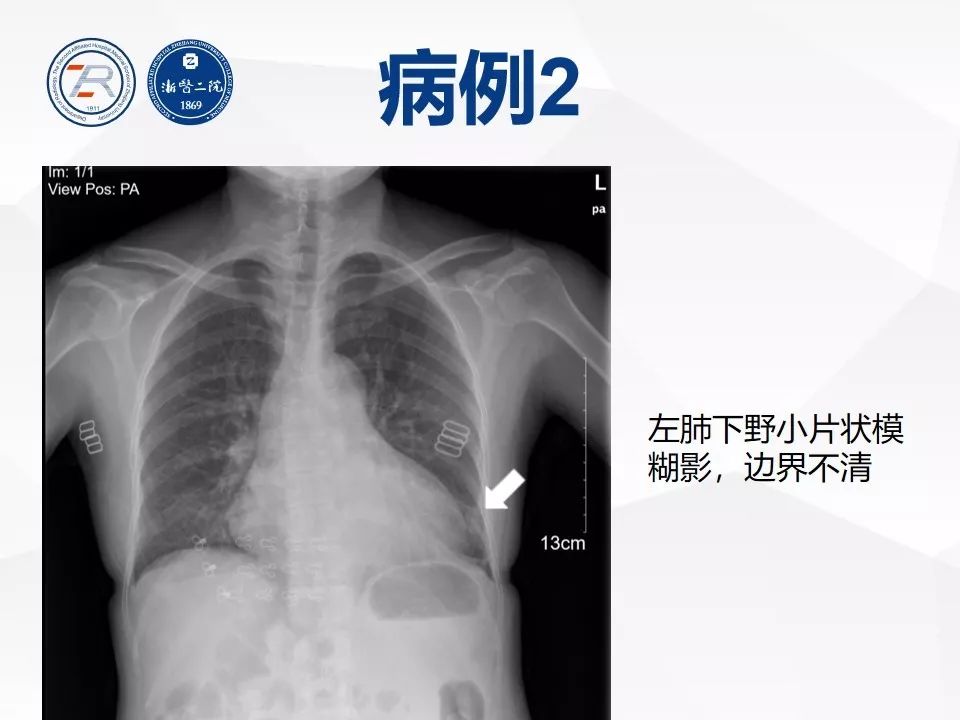 【PPT】新型冠状病毒肺炎早知道—胸片细节见真章（肺炎和病毒性肺炎X线诊断