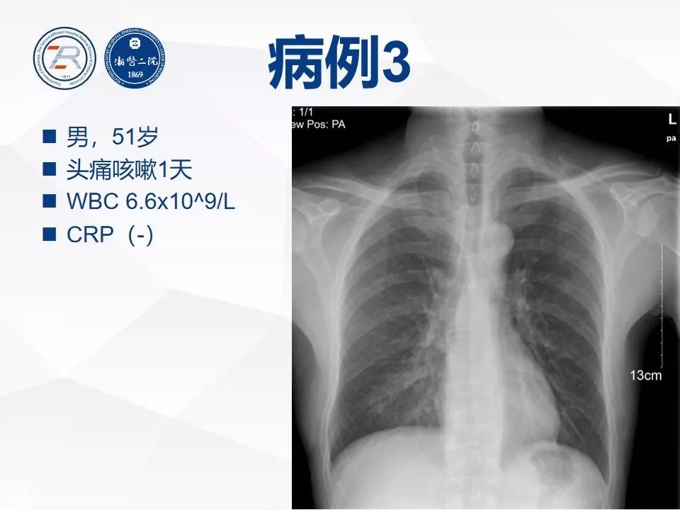 【PPT】新型冠状病毒肺炎早知道—胸片细节见真章（肺炎和病毒性肺炎X线诊断