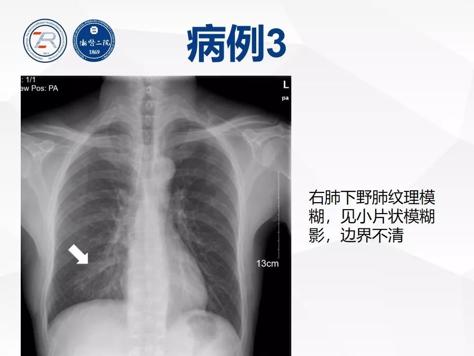 【PPT】新型冠状病毒肺炎早知道—胸片细节见真章（肺炎和病毒性肺炎X线诊断