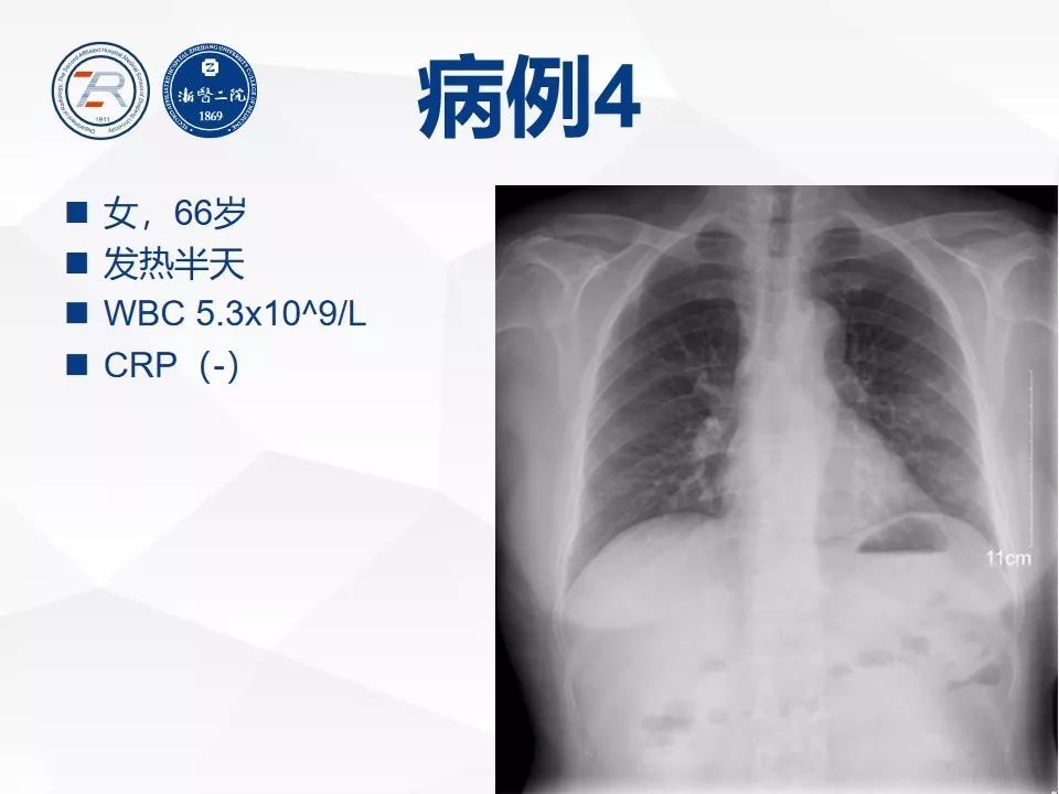 【PPT】新型冠状病毒肺炎早知道—胸片细节见真章（肺炎和病毒性肺炎X线诊断