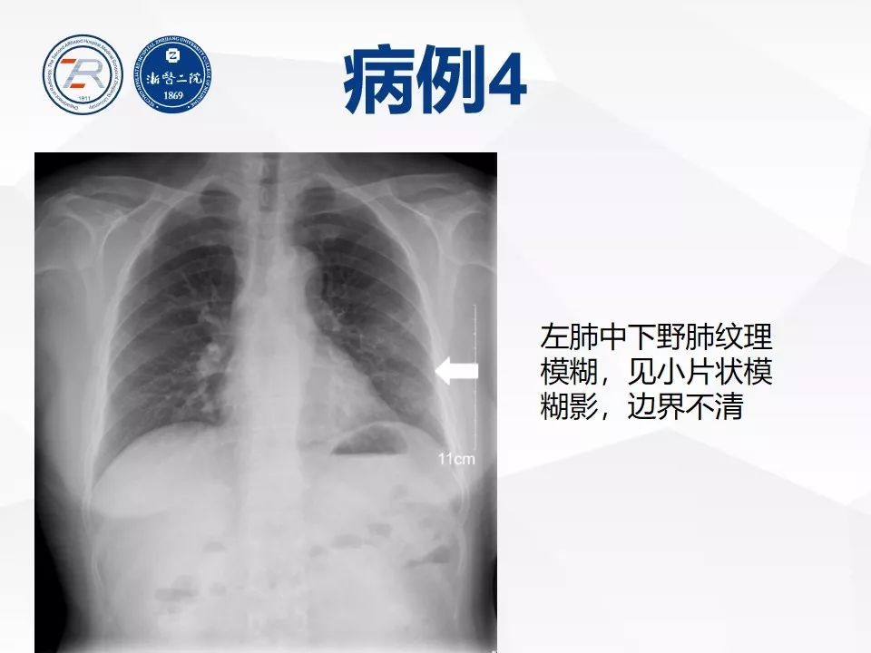 【PPT】新型冠状病毒肺炎早知道—胸片细节见真章（肺炎和病毒性肺炎X线诊断