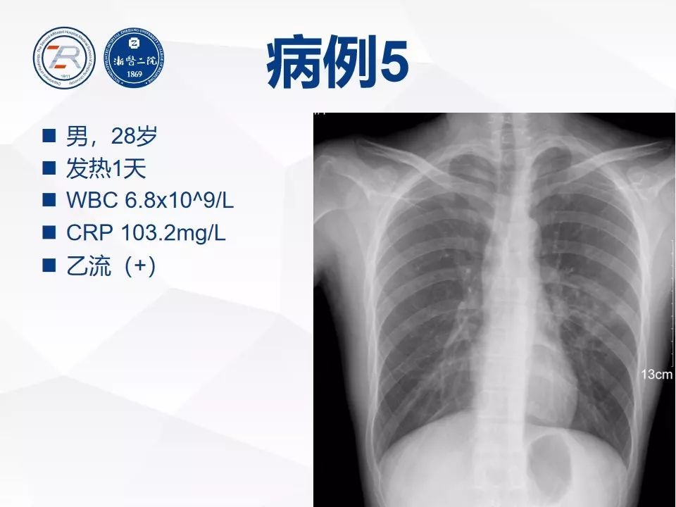 【PPT】新型冠状病毒肺炎早知道—胸片细节见真章（肺炎和病毒性肺炎X线诊断