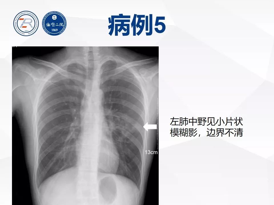 【PPT】新型冠状病毒肺炎早知道—胸片细节见真章（肺炎和病毒性肺炎X线诊断