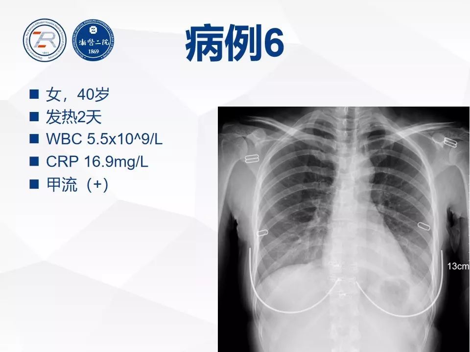【PPT】新型冠状病毒肺炎早知道—胸片细节见真章（肺炎和病毒性肺炎X线诊断