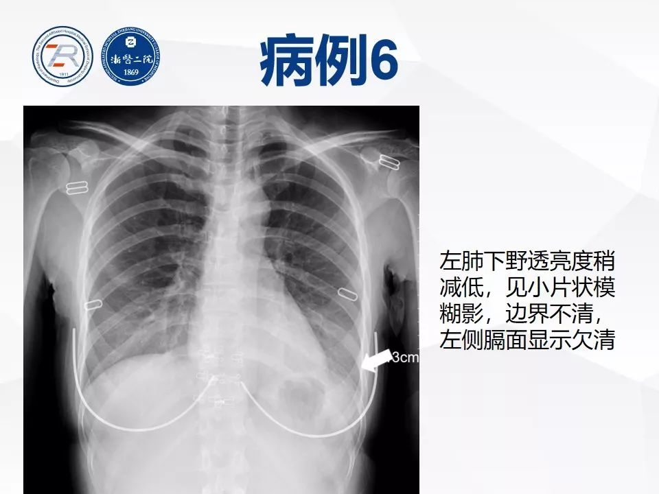 【PPT】新型冠状病毒肺炎早知道—胸片细节见真章（肺炎和病毒性肺炎X线诊断