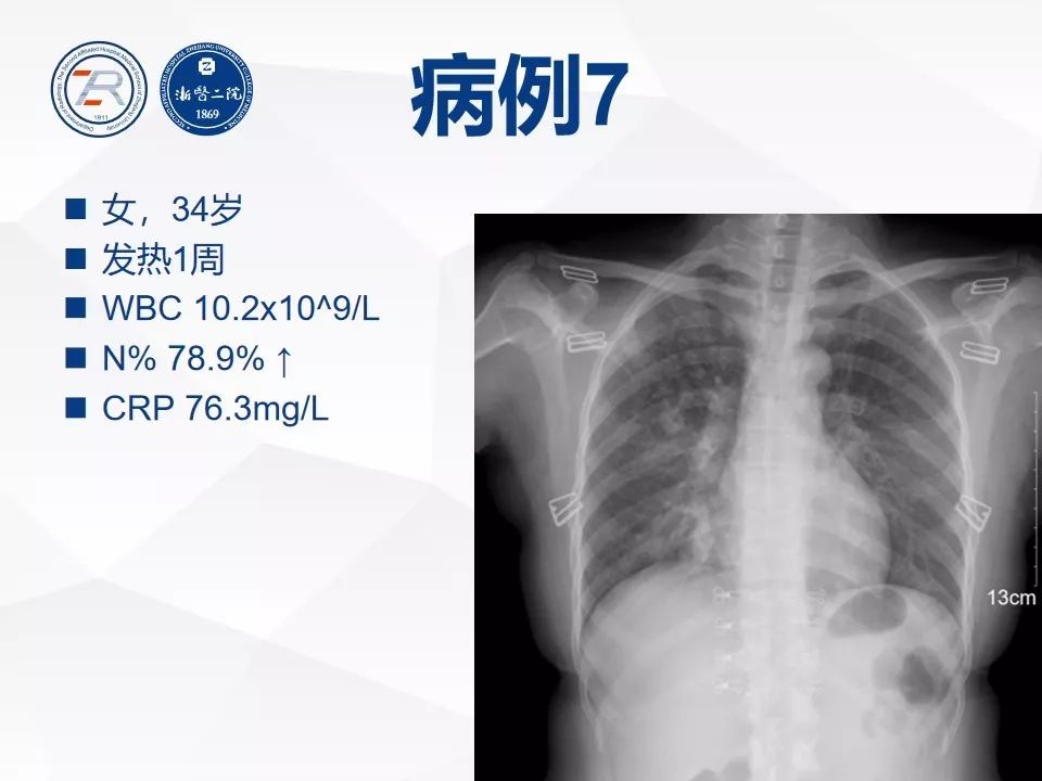 【PPT】新型冠状病毒肺炎早知道—胸片细节见真章（肺炎和病毒性肺炎X线诊断
