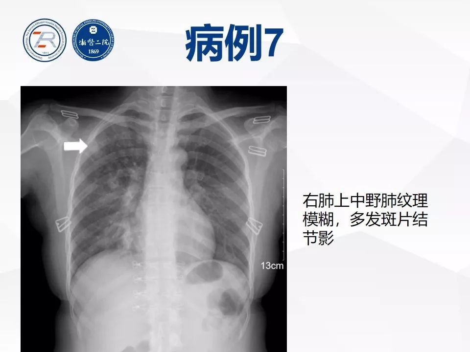 【PPT】新型冠状病毒肺炎早知道—胸片细节见真章（肺炎和病毒性肺炎X线诊断