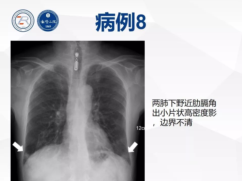 【PPT】新型冠状病毒肺炎早知道—胸片细节见真章（肺炎和病毒性肺炎X线诊断