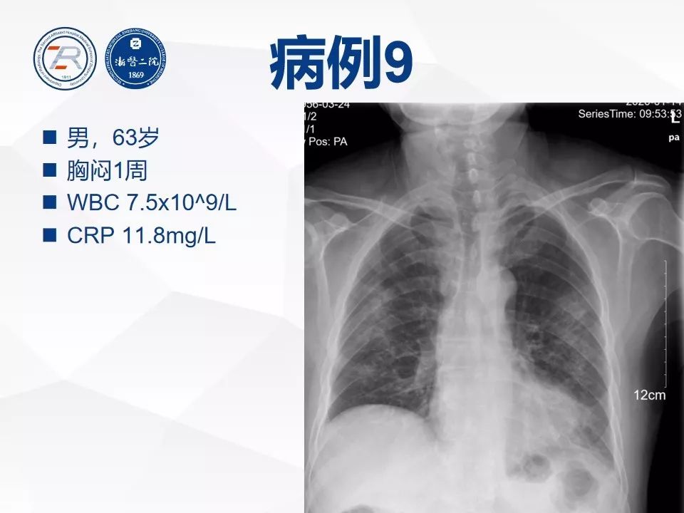 【PPT】新型冠状病毒肺炎早知道—胸片细节见真章（肺炎和病毒性肺炎X线诊断