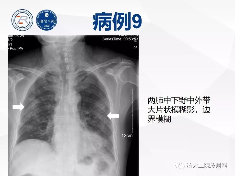 【PPT】新型冠状病毒肺炎早知道—胸片细节见真章（肺炎和病毒性肺炎X线诊断