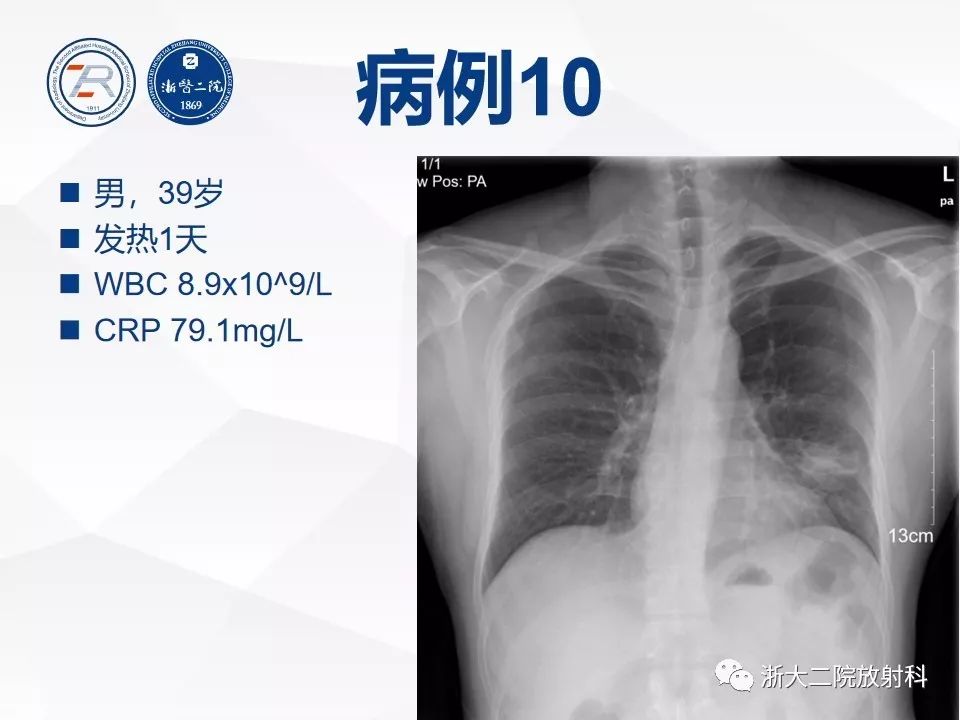 【PPT】新型冠状病毒肺炎早知道—胸片细节见真章（肺炎和病毒性肺炎X线诊断