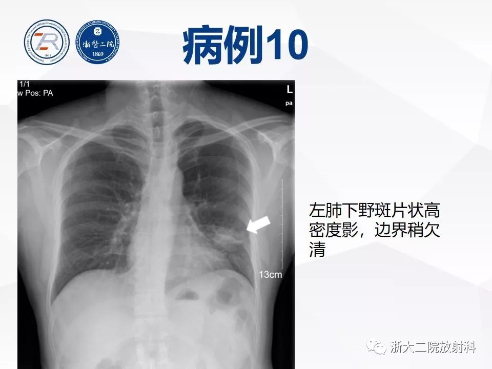 【PPT】新型冠状病毒肺炎早知道—胸片细节见真章（肺炎和病毒性肺炎X线诊断