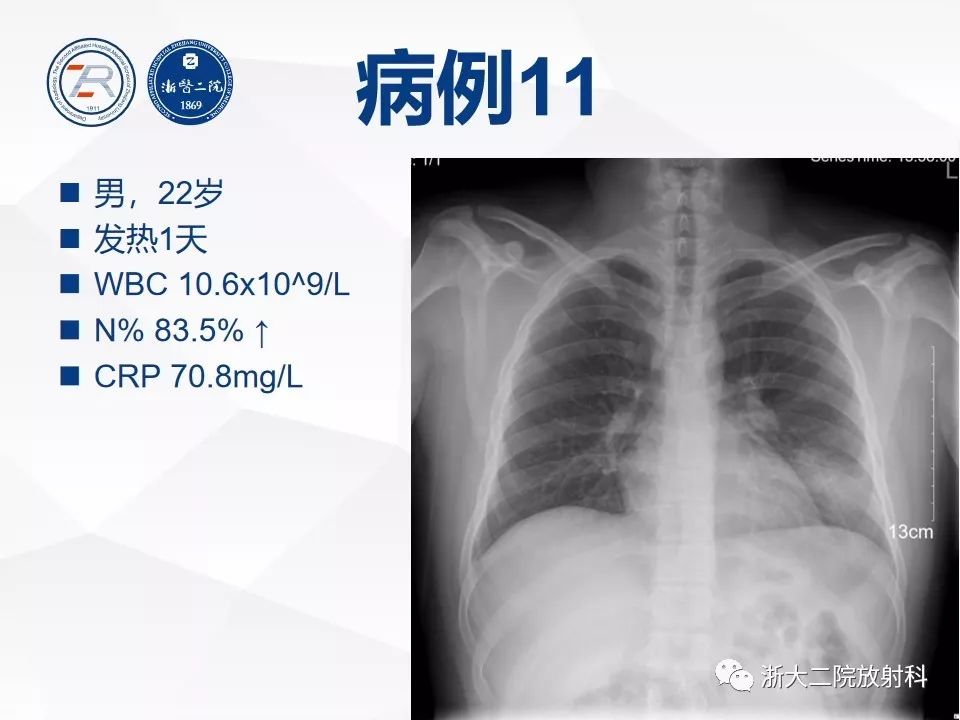 【PPT】新型冠状病毒肺炎早知道—胸片细节见真章（肺炎和病毒性肺炎X线诊断