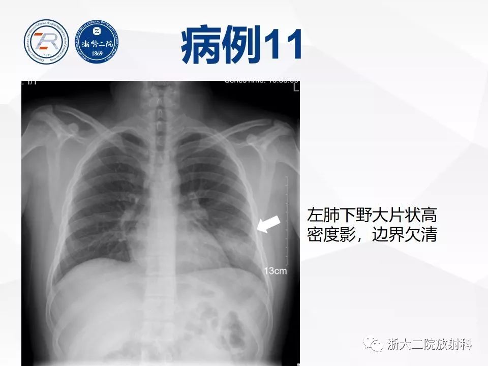 【PPT】新型冠状病毒肺炎早知道—胸片细节见真章（肺炎和病毒性肺炎X线诊断