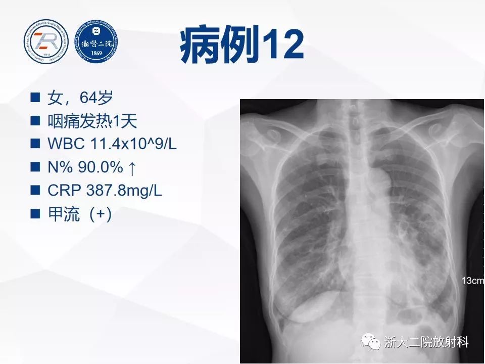 【PPT】新型冠状病毒肺炎早知道—胸片细节见真章（肺炎和病毒性肺炎X线诊断
