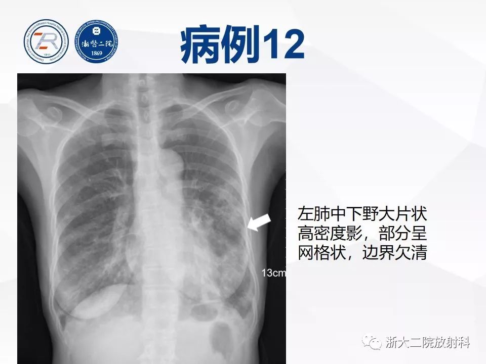【PPT】新型冠状病毒肺炎早知道—胸片细节见真章（肺炎和病毒性肺炎X线诊断
