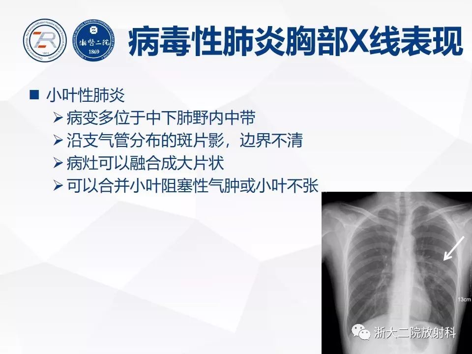 【PPT】新型冠状病毒肺炎早知道—胸片细节见真章（肺炎和病毒性肺炎X线诊断
