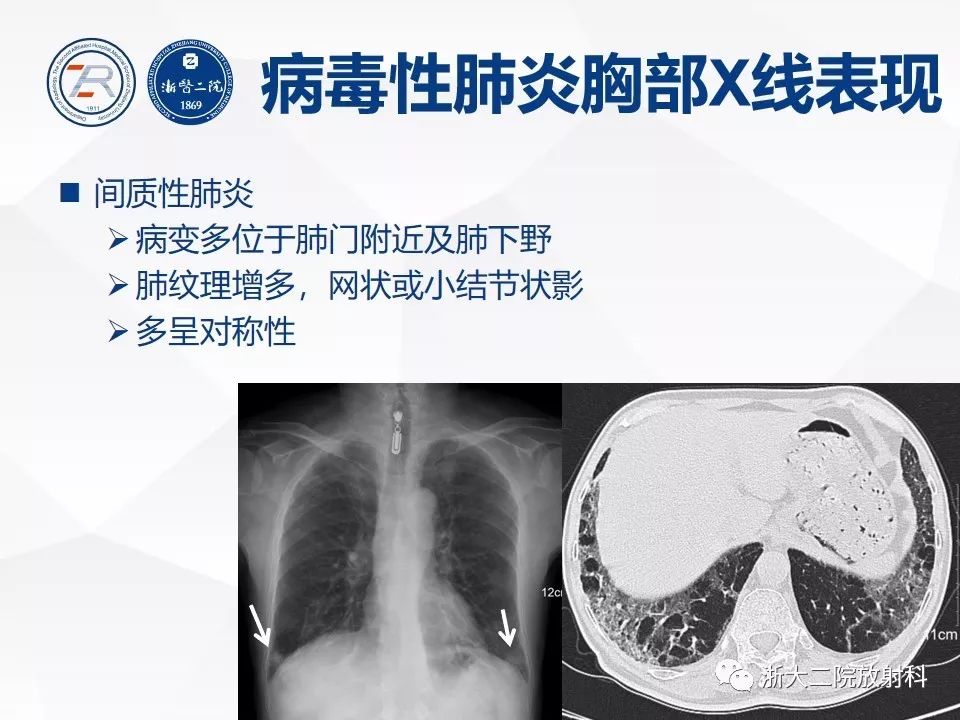 【PPT】新型冠状病毒肺炎早知道—胸片细节见真章（肺炎和病毒性肺炎X线诊断