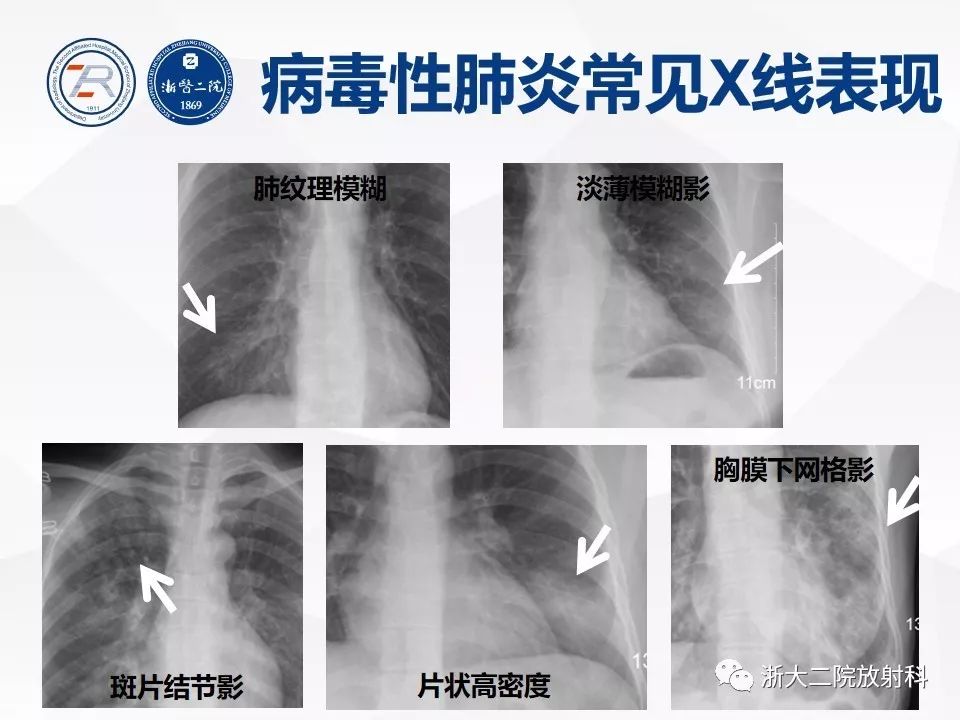 【PPT】新型冠状病毒肺炎早知道—胸片细节见真章（肺炎和病毒性肺炎X线诊断