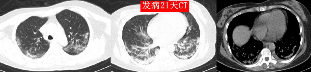 新型冠状病毒肺炎的影像学表现 新型冠状病毒肺炎的影像学表现