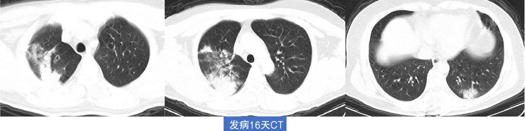 新型冠状病毒肺炎的影像学表现 新型冠状病毒肺炎的影像学表现