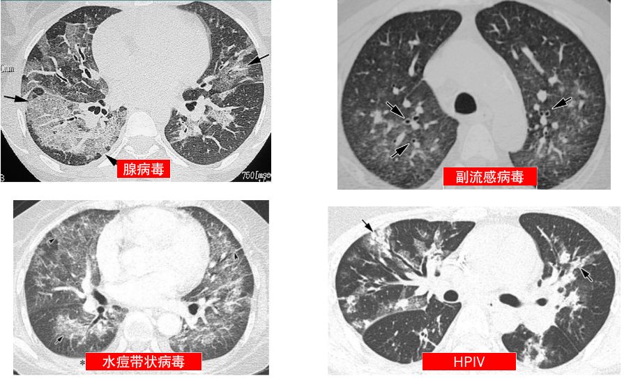 新型冠状病毒肺炎的影像学表现 新型冠状病毒肺炎的影像学表现