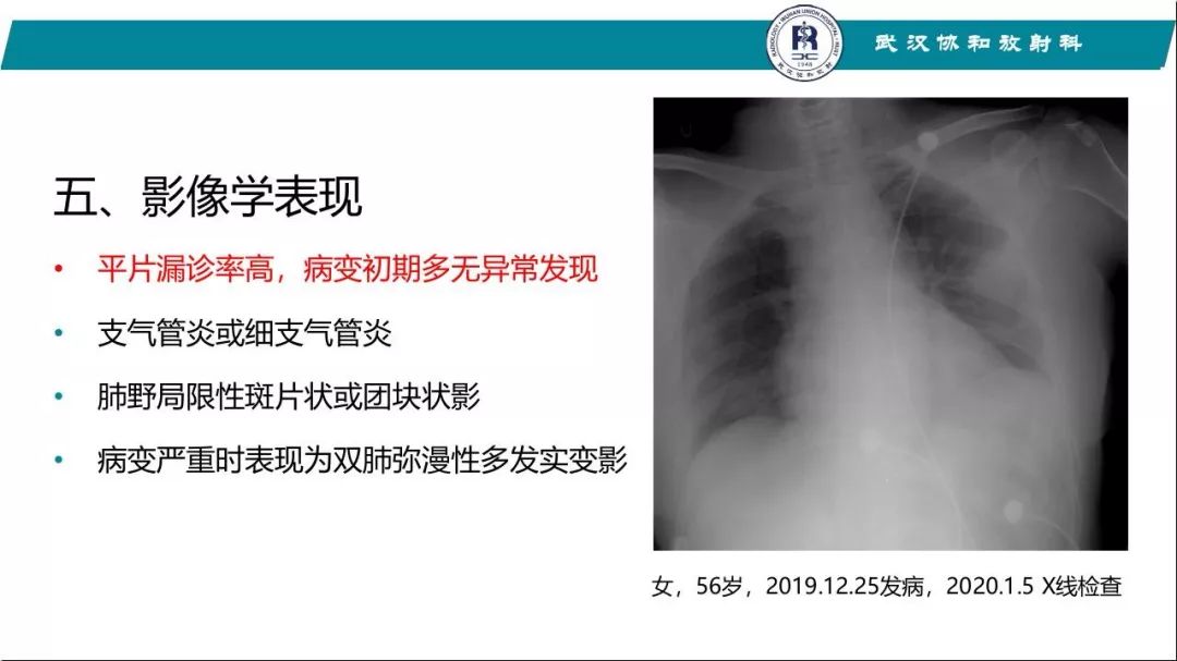 【PPT】武汉19-nCoV 肺炎（新型冠状病毒肺炎）影像学表现初探