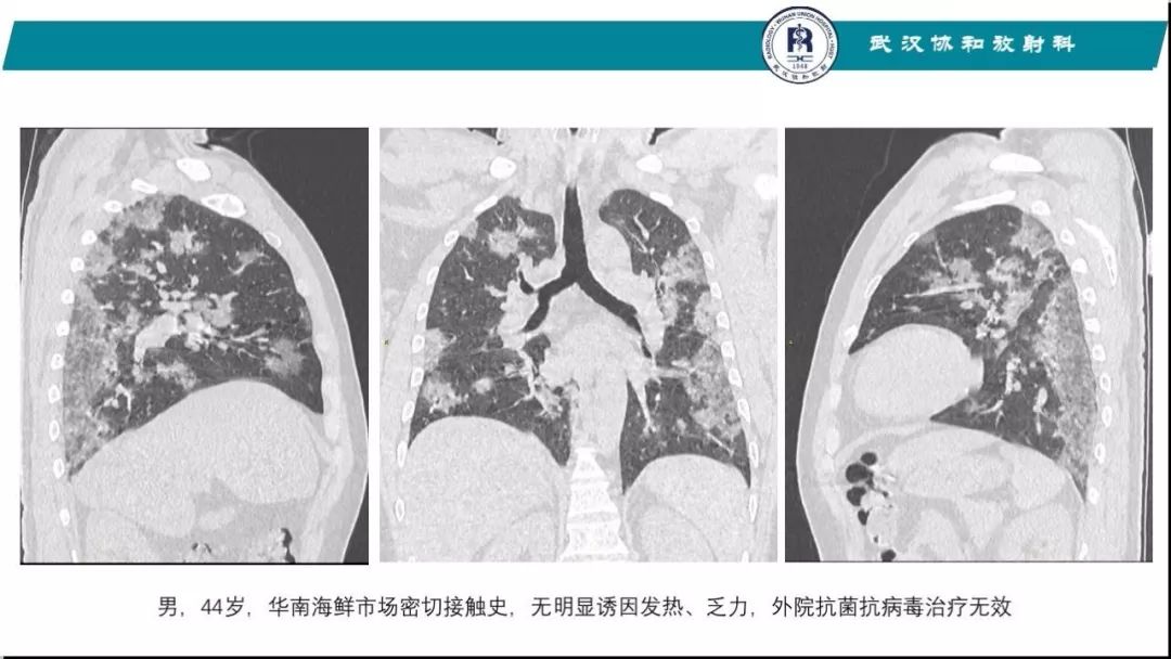 【PPT】武汉19-nCoV 肺炎（新型冠状病毒肺炎）影像学表现初探