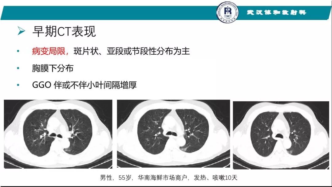【PPT】武汉19-nCoV 肺炎（新型冠状病毒肺炎）影像学表现初探