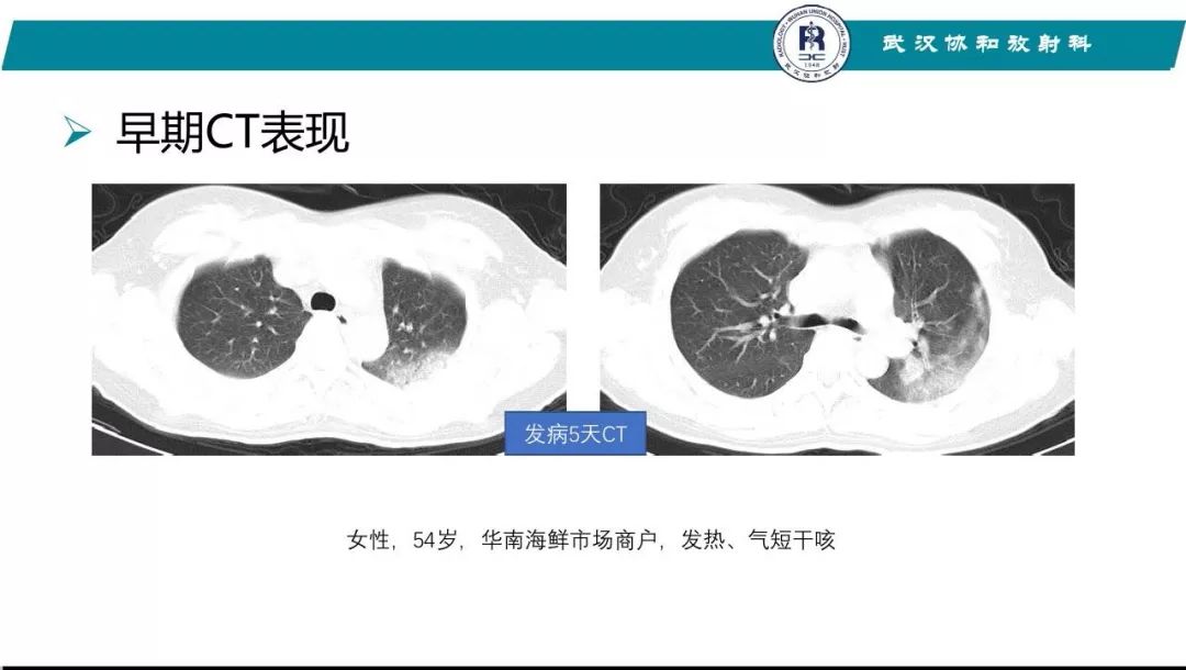 【PPT】武汉19-nCoV 肺炎（新型冠状病毒肺炎）影像学表现初探