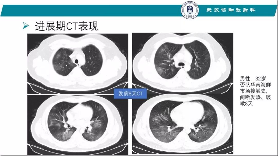 【PPT】武汉19-nCoV 肺炎（新型冠状病毒肺炎）影像学表现初探