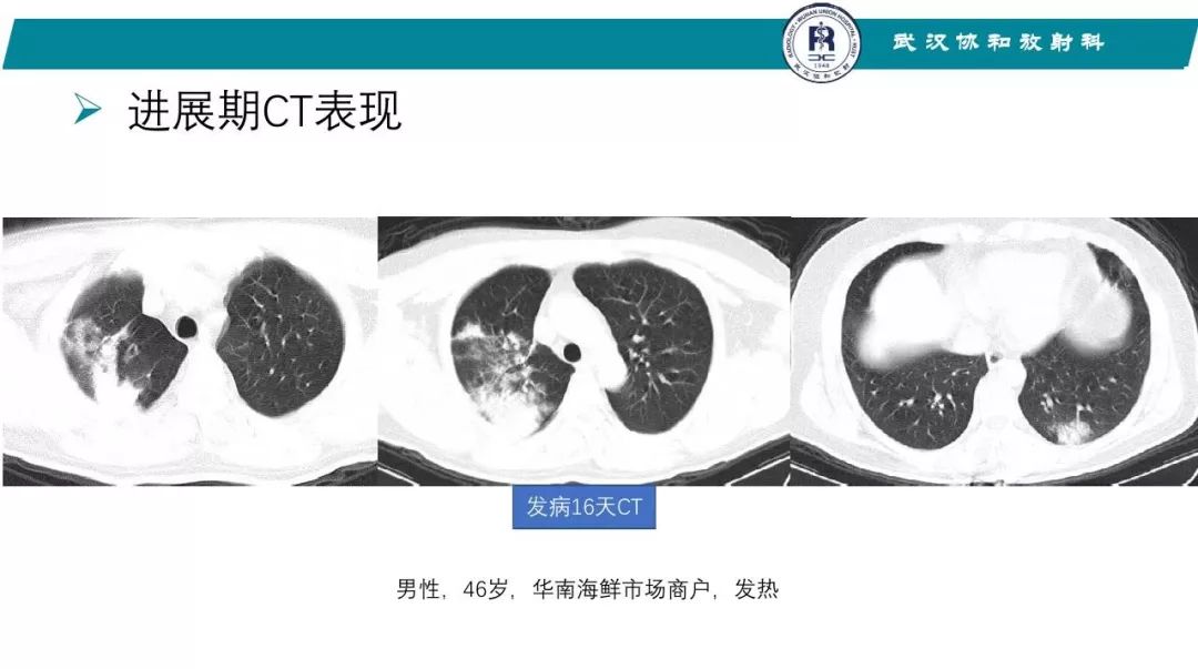 【PPT】武汉19-nCoV 肺炎（新型冠状病毒肺炎）影像学表现初探