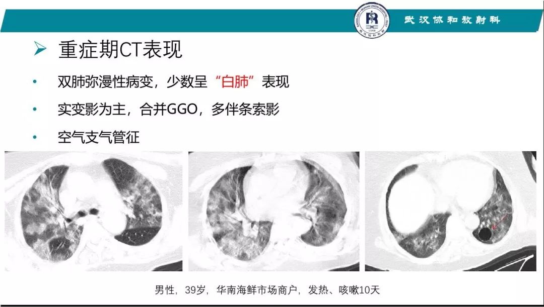 【PPT】武汉19-nCoV 肺炎（新型冠状病毒肺炎）影像学表现初探