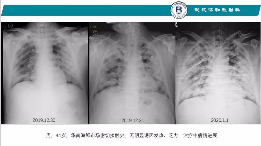 【PPT】武汉19-nCoV 肺炎（新型冠状病毒肺炎）影像学表现初探