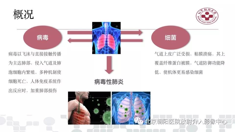 【PPT】病毒性肺炎影像诊断思路