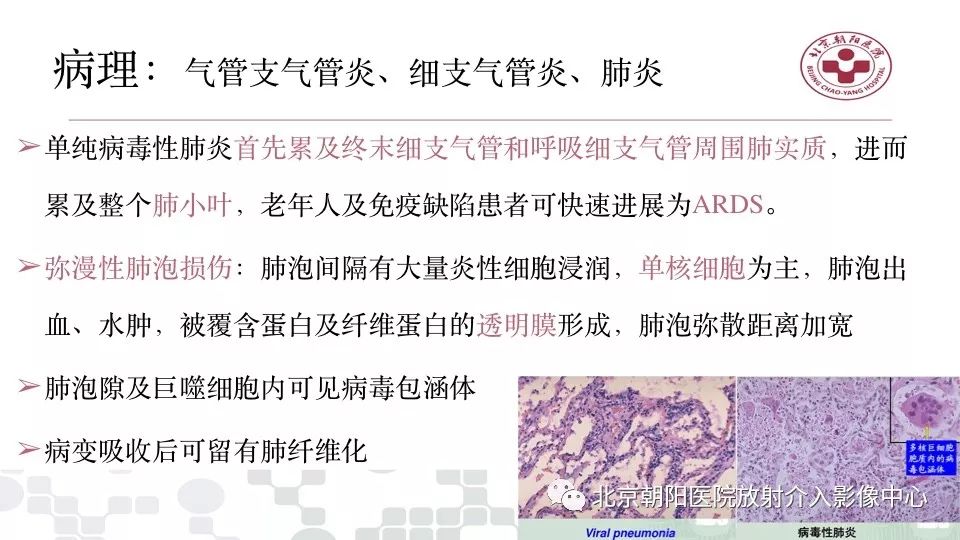 【PPT】病毒性肺炎影像诊断思路