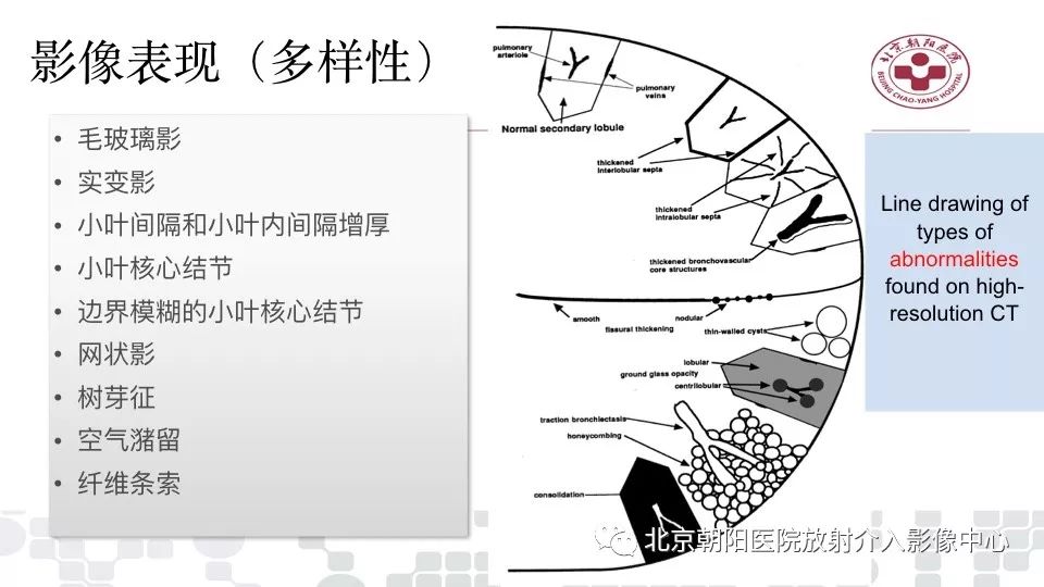 【PPT】病毒性肺炎影像诊断思路