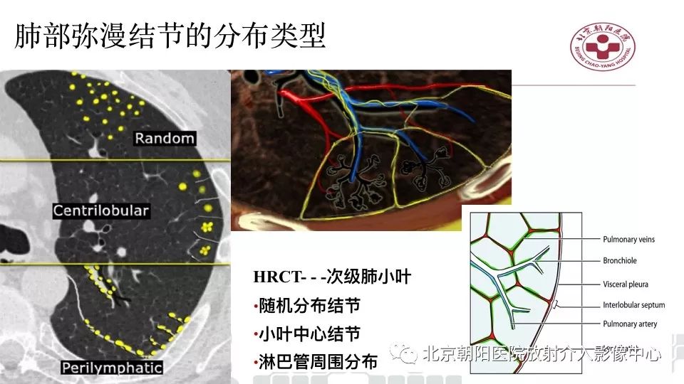 【PPT】病毒性肺炎影像诊断思路