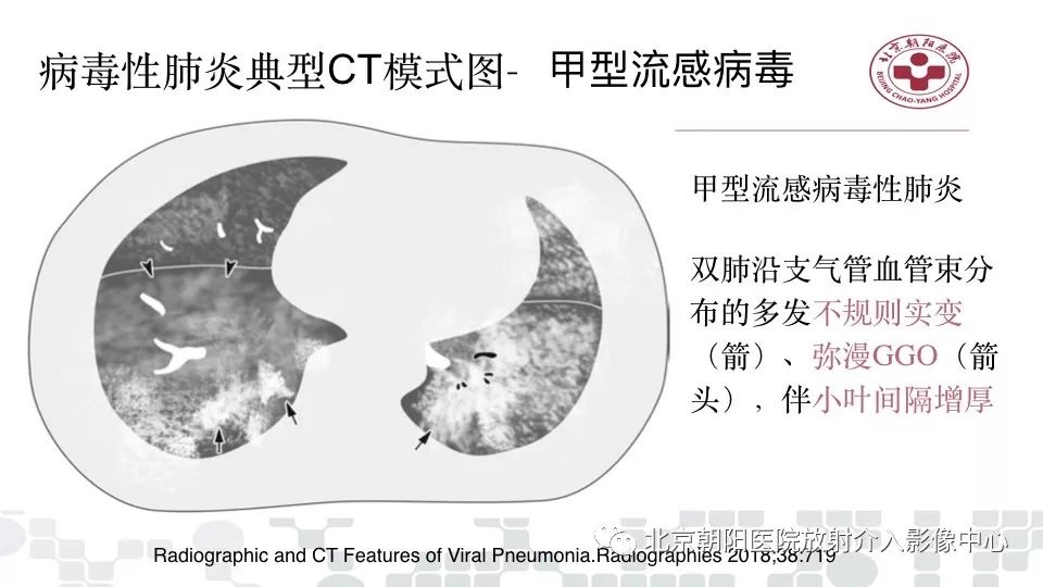 【PPT】病毒性肺炎影像诊断思路