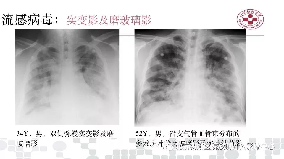 【PPT】病毒性肺炎影像诊断思路