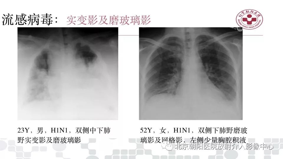 【PPT】病毒性肺炎影像诊断思路
