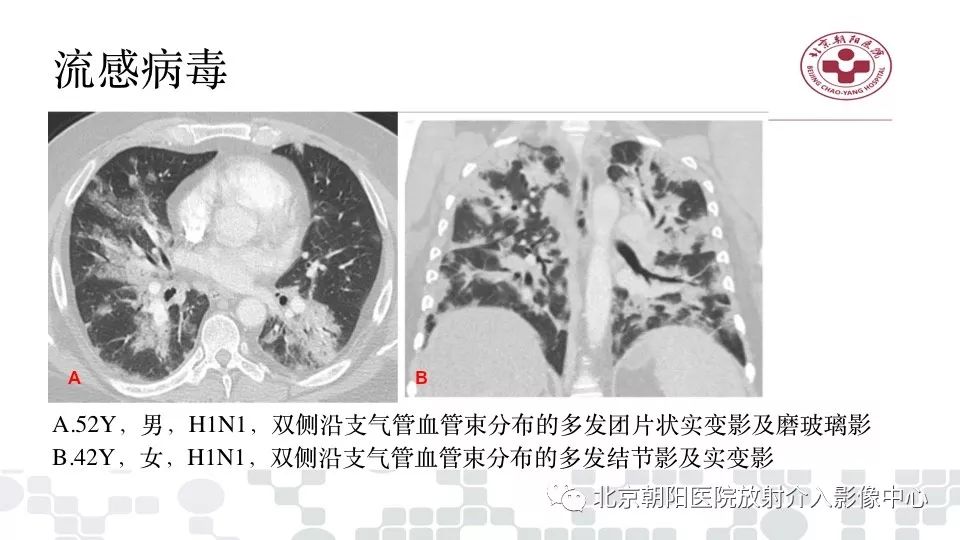 【PPT】病毒性肺炎影像诊断思路
