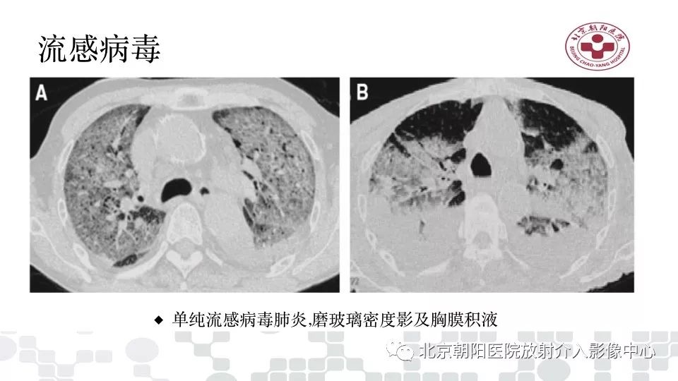 【PPT】病毒性肺炎影像诊断思路